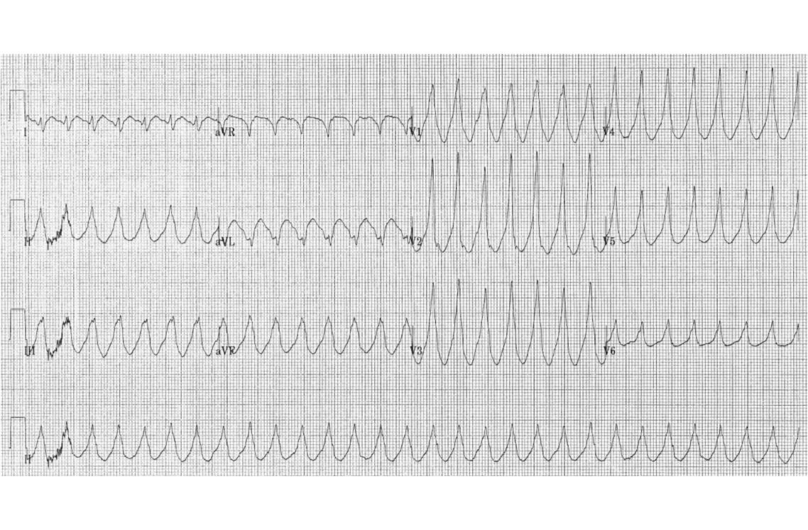 Propranolol sans ordonnance